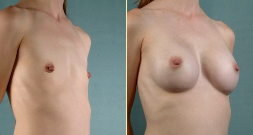 Breast Enhancement Colorado