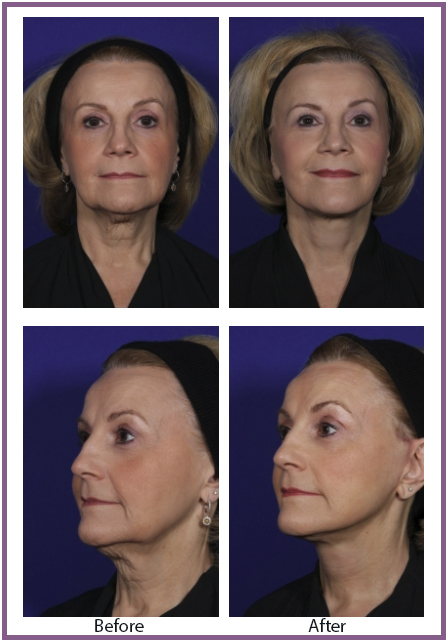 Facelift Denver Before and After | Denver Patient