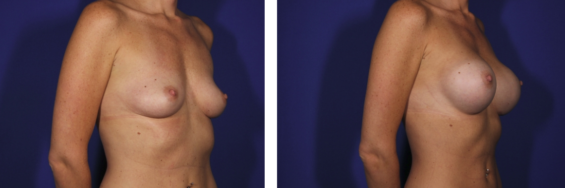 Denver Breast Enhancement patient | Denver Breast Surgery Before and After
