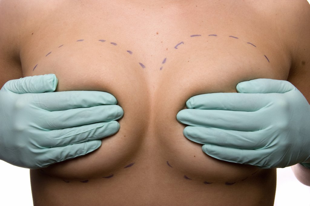 If you are considering breast augmentation in Colorado, call board-certified plastic surgeon Dr. Paul Zwiebel at 303-470-3400 to schedule a consultation and learn all about your options