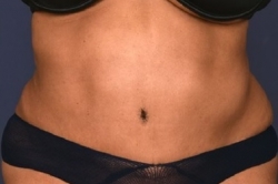 360 Degrees Midsection liposuction & contouring with "VASER" Skin tightening technology. 