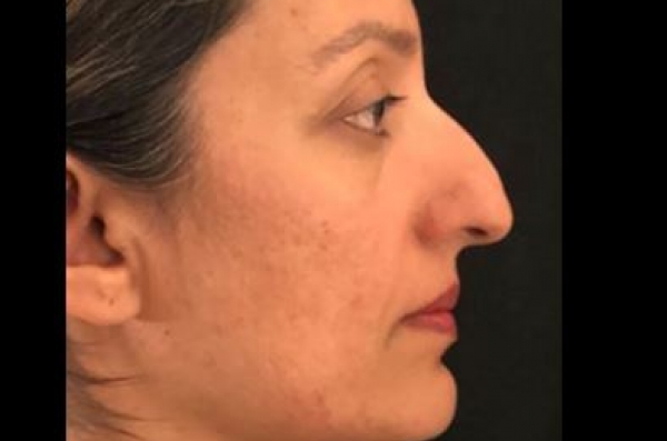 Dr. Kamran Dastoury Rhinoplasty