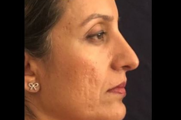 Dr. Kamran Dastoury Rhinoplasty